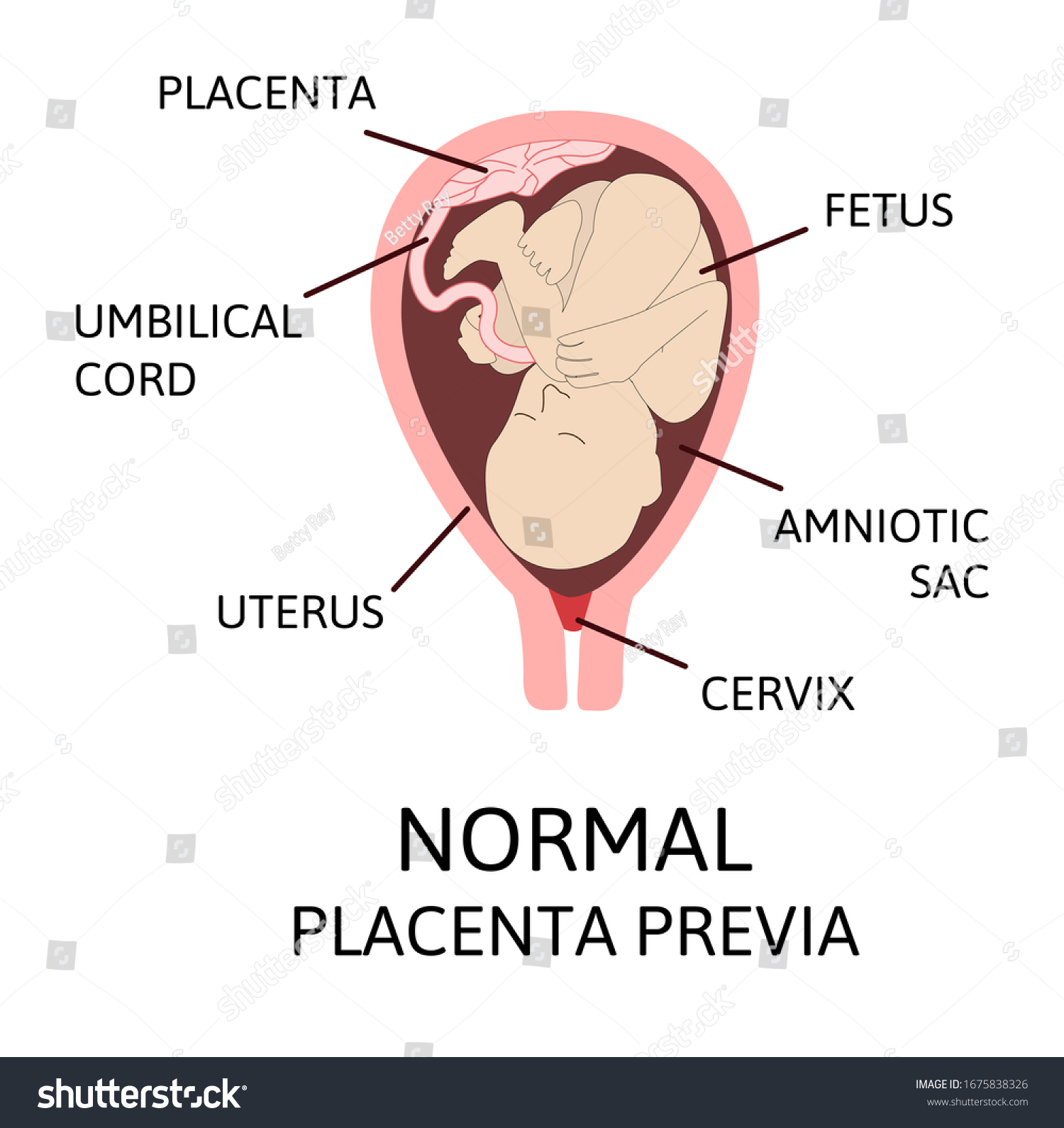 Normal Placental Locations During Pregnancy Detailed Stock Vector 