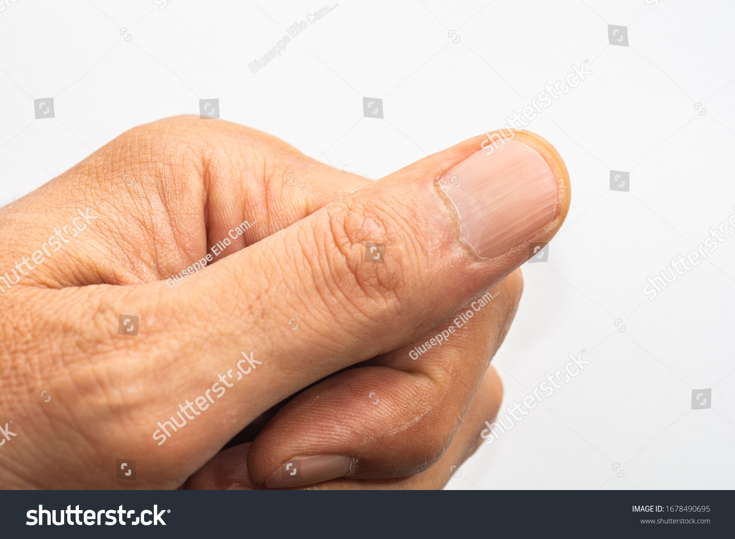 Vertical Ridges On Fingernails Symptoms Deficiency Foto stock