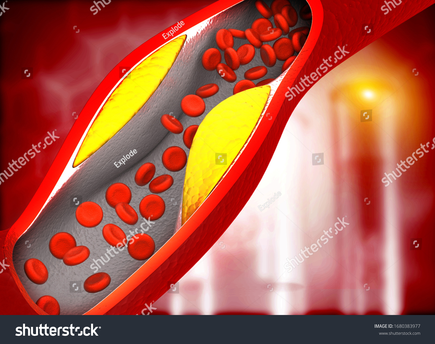 Clogged Arteriesblocked Blood Vessel Artery Bad Stock Illustration ...