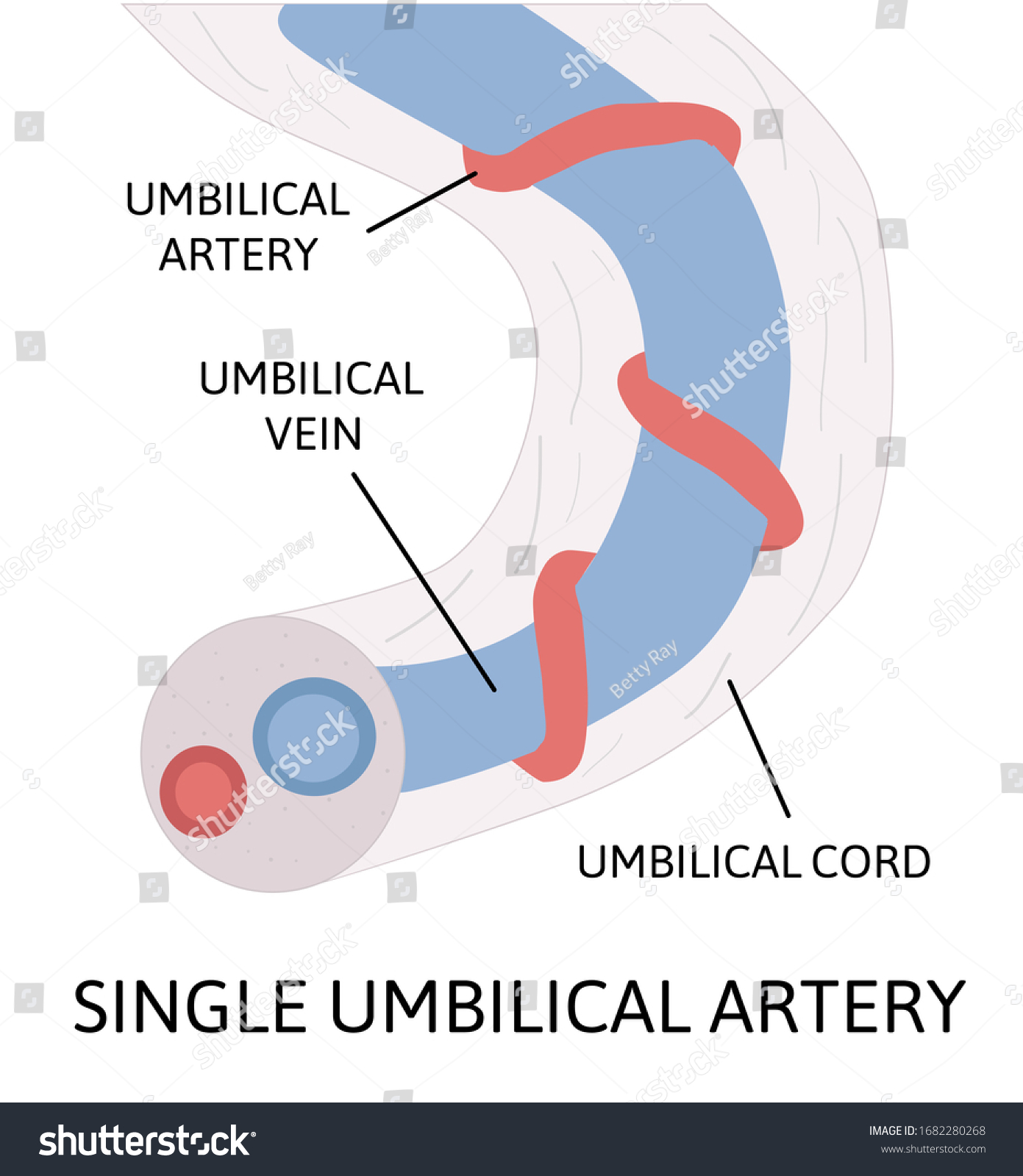 Single Umbilical Artery Anatomy Umbilical Cord Stock Vector (Royalty ...