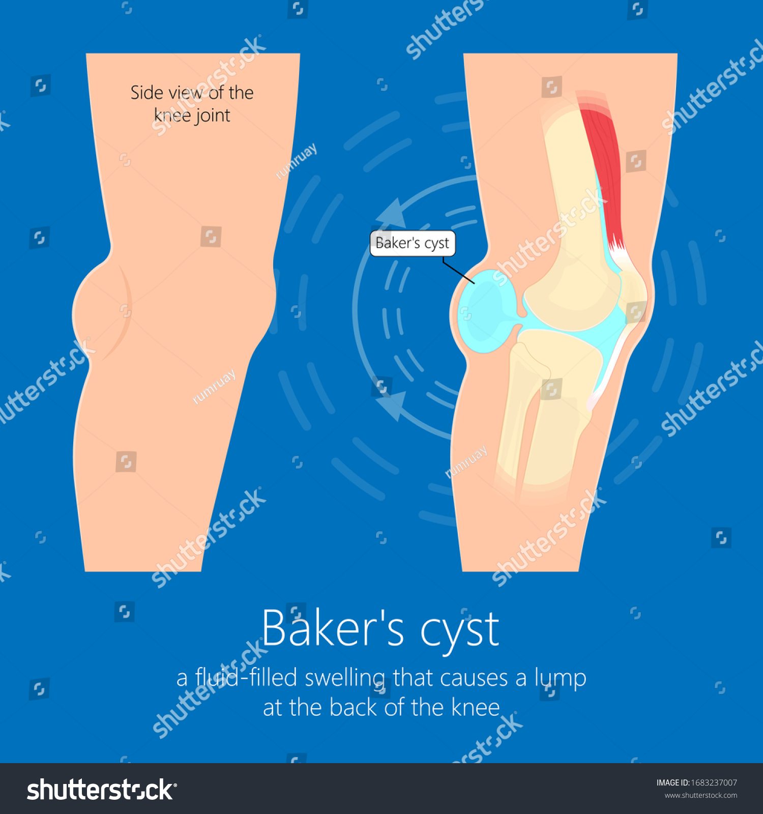 Bakers Cyst Popliteal Swelling Knee Joint Stock Vector Royalty Free 1683237007 Shutterstock