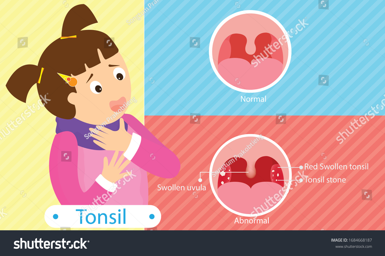 tonsillitis-throat-diseases-vector-illustration-1684668187