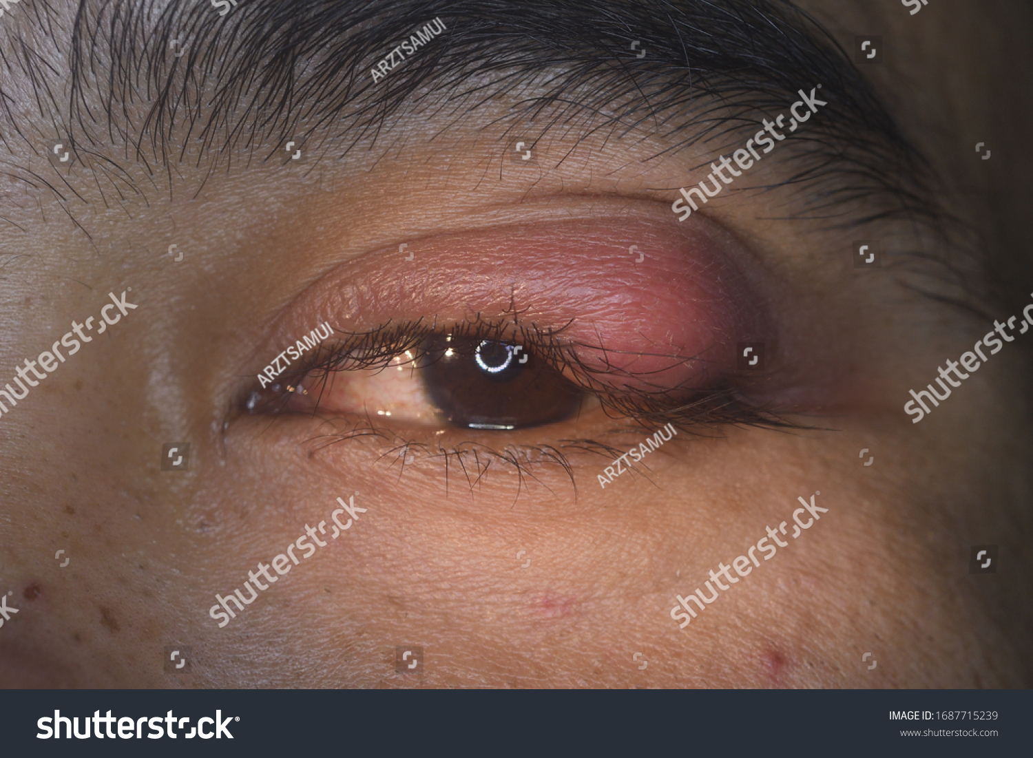 Close Stye Hordeolum Chalazion Eyelid Infection Stock Photo 1687715239