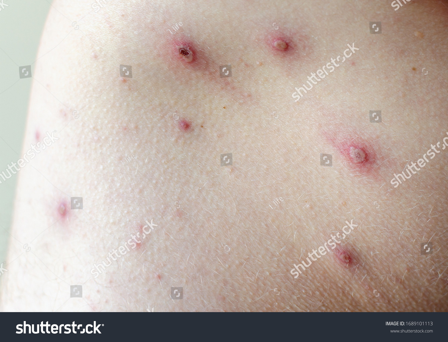 large-spots-pimples-acne-on-body-stock-photo-1689101113-shutterstock