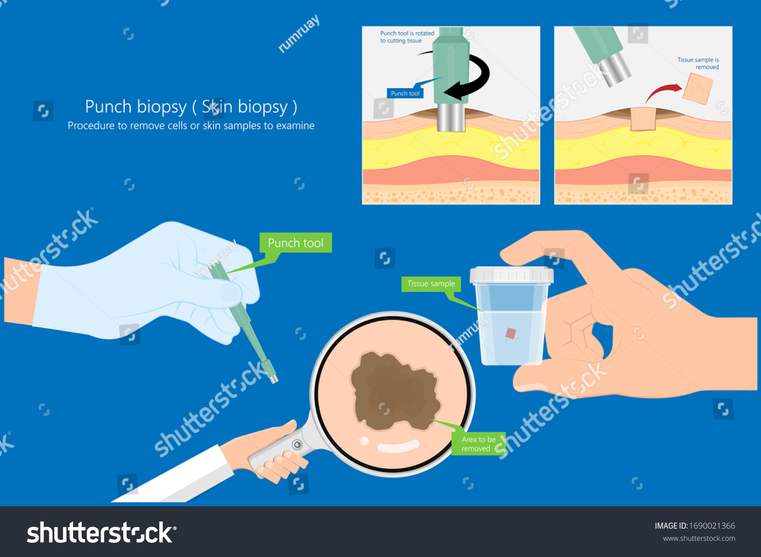 Skin Biopsy Dermoscope Tool Surgical Diagnose Stock Vector Royalty Free 1690021366 Shutterstock