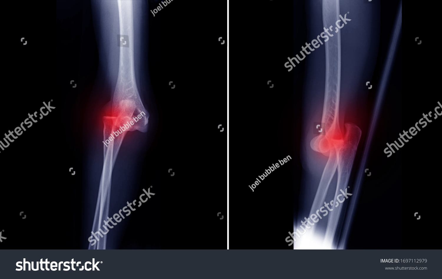 Film Xray Elbow Radiograph Show Elbow Stock Photo 1697112979 | Shutterstock