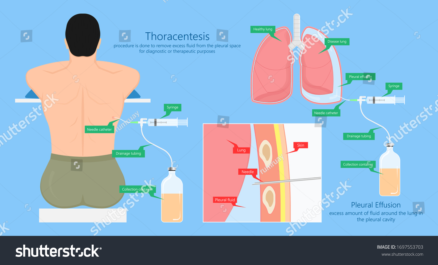 Vats Lung Cancer Treatment Sub Pus Stock Vector Royalty Free 1697553703 Shutterstock