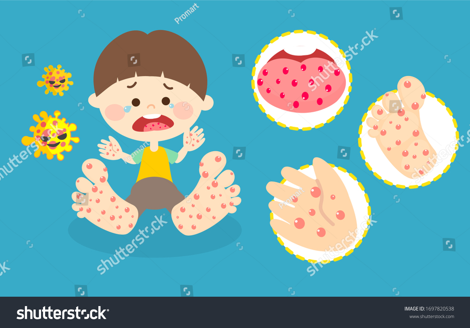 Hand Foot Mouth Disease Vector Stock Vector (Royalty Free) 1697820538 ...