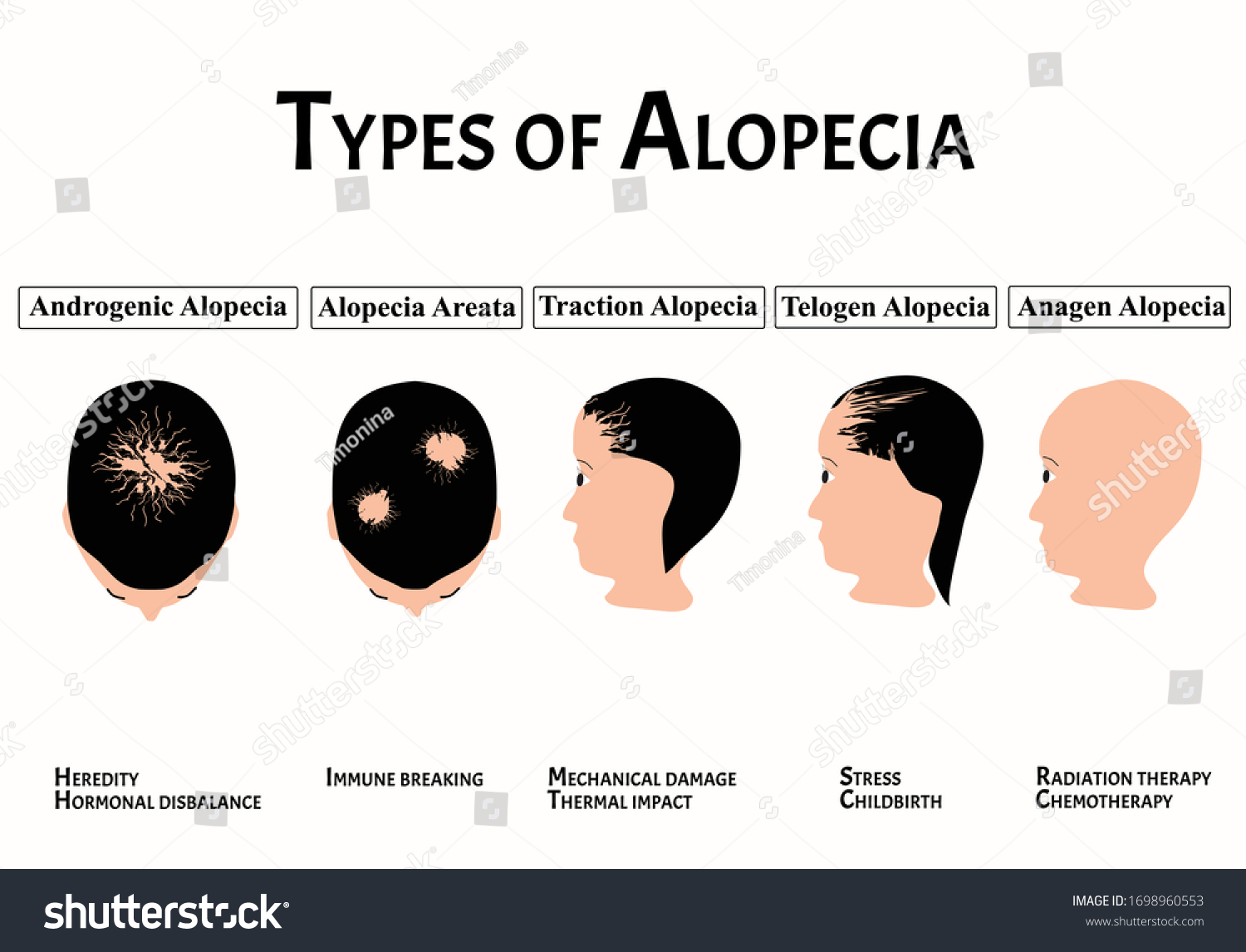 Types Alopecia Bald Spot Baldness Alopecia: Vector Có Sẵn (miễn Phí Bản ...