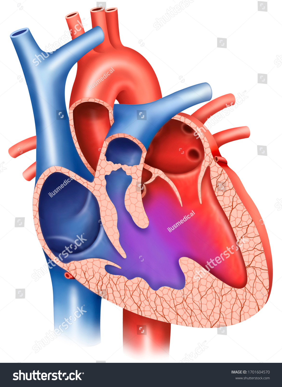 Illustration On Ventricular Septal Defect Ventricular Stock ...