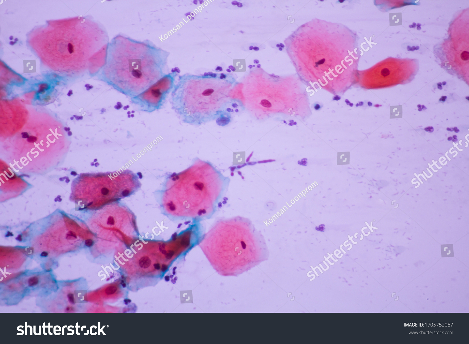 View Microscopic Candidiasis Fungus Infection Yeast Stock Photo ...