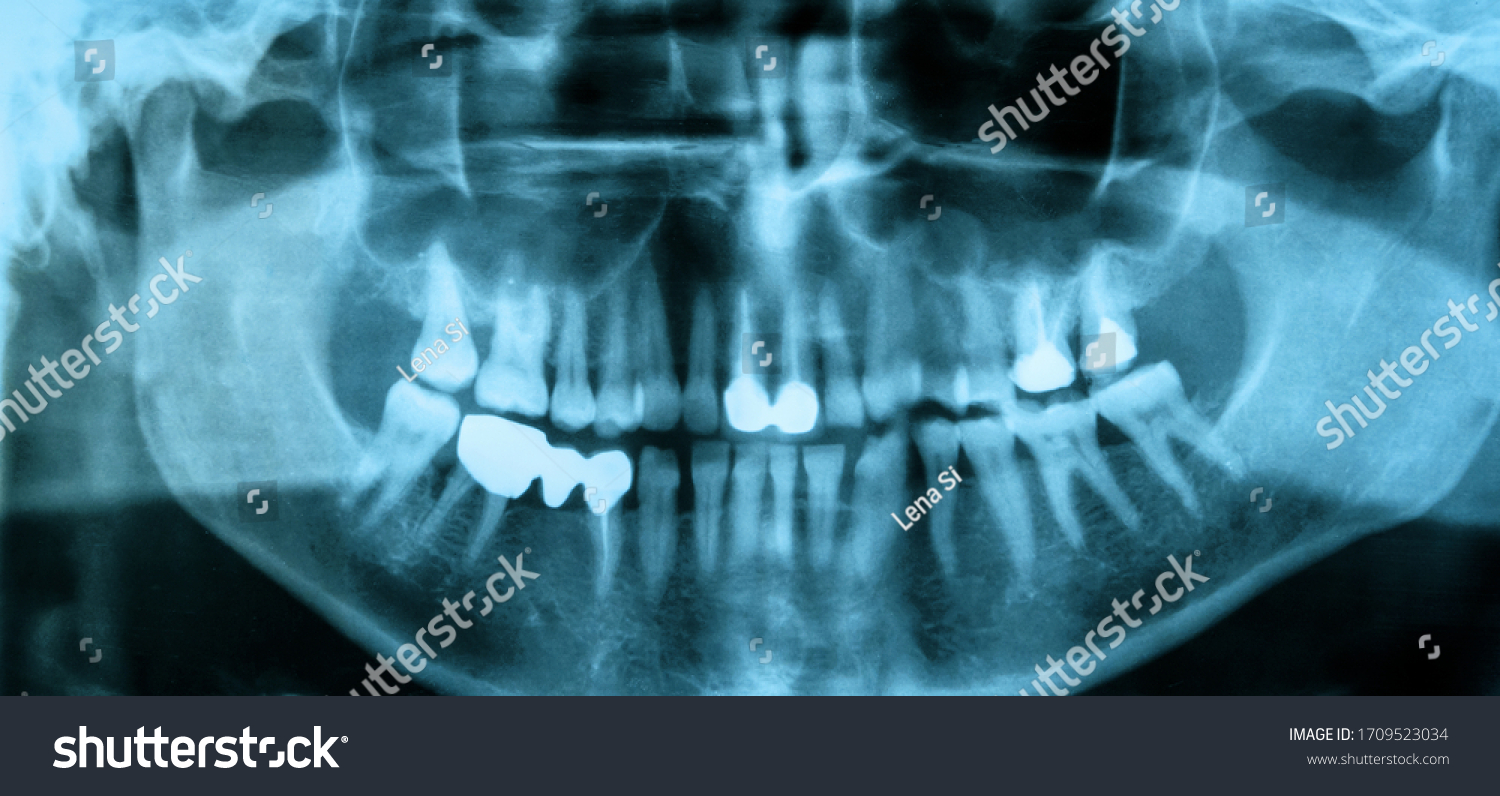 Photo Dental Xray Panoramic Xray Mouth Stock Photo 1709523034 ...