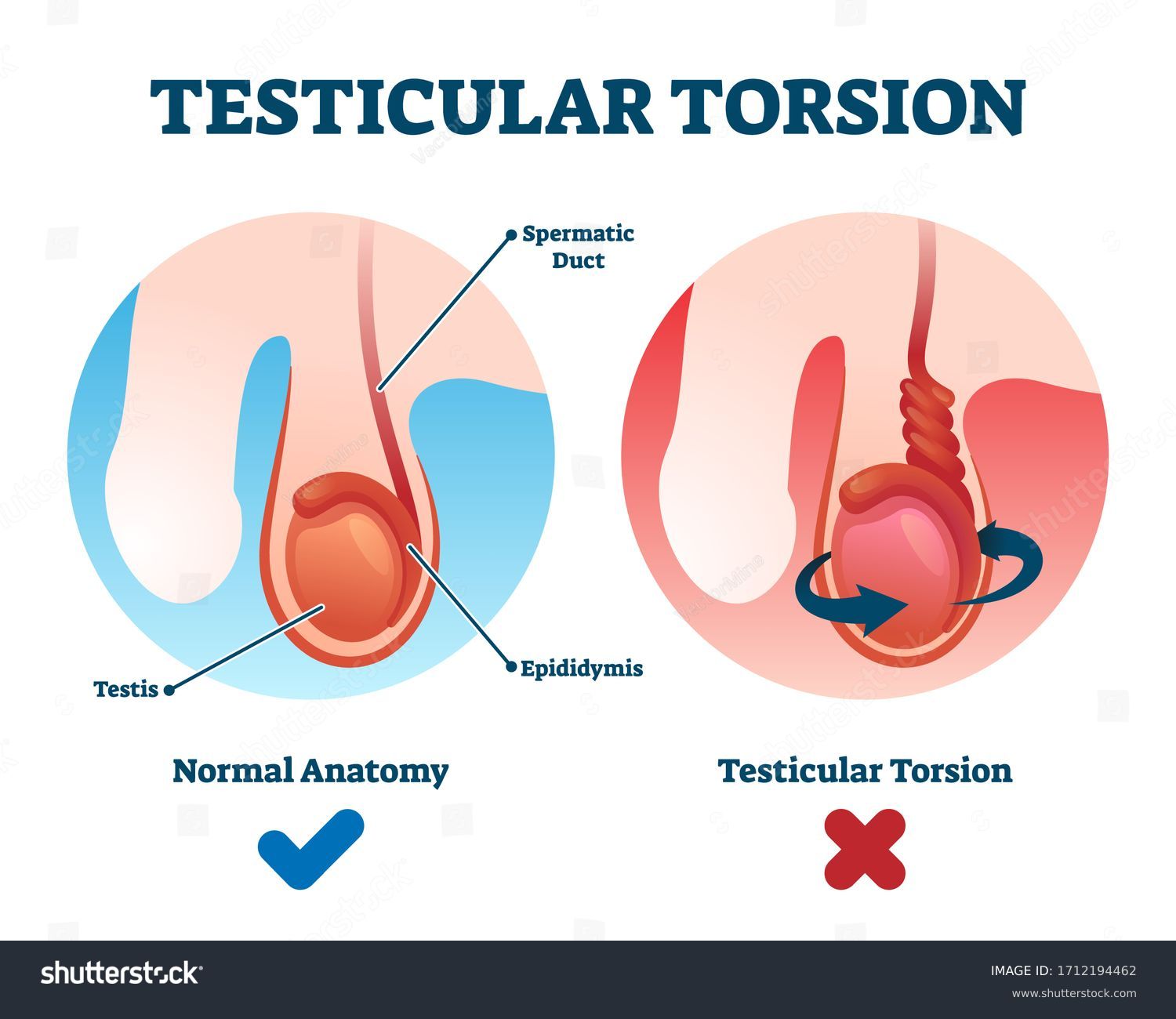 testicular-torsion-vector-illustration-labeled-spermatic-stock-vector