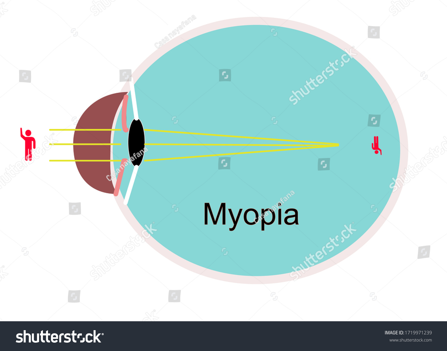 Myopia Diagrammatic Illustration Long Sightedness Stock Vector Royalty