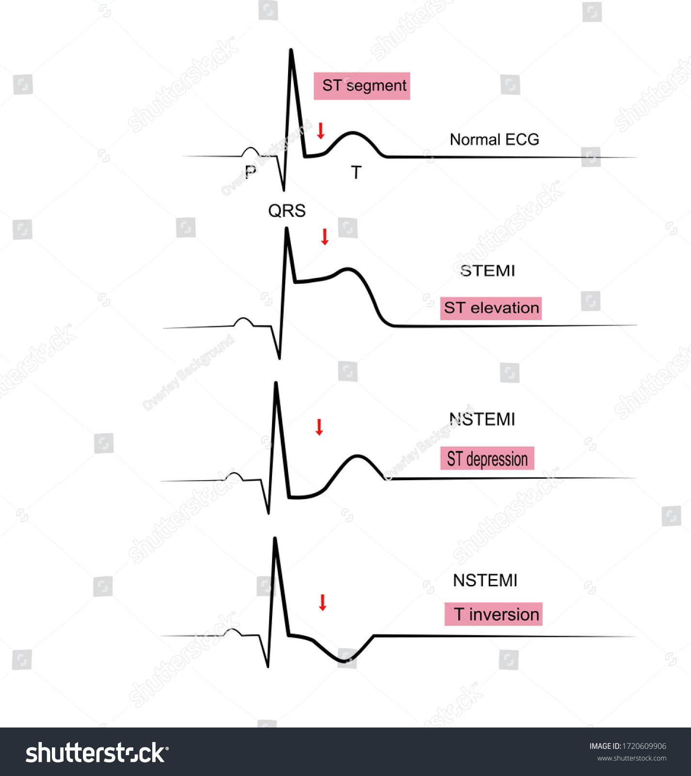 1lead Ecg Stemist Elevation Myocardial Infraction Stok Vektör Telifsiz