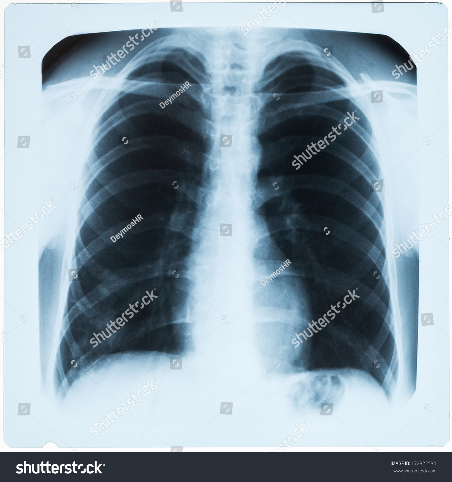 Xray Mans Lungs During Pneumonia Stock Photo 172322534 | Shutterstock