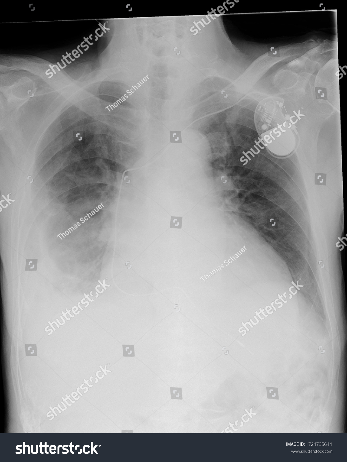 Posterior Anterior Chest Xray Showing Signs Stock Photo 1724735644 ...