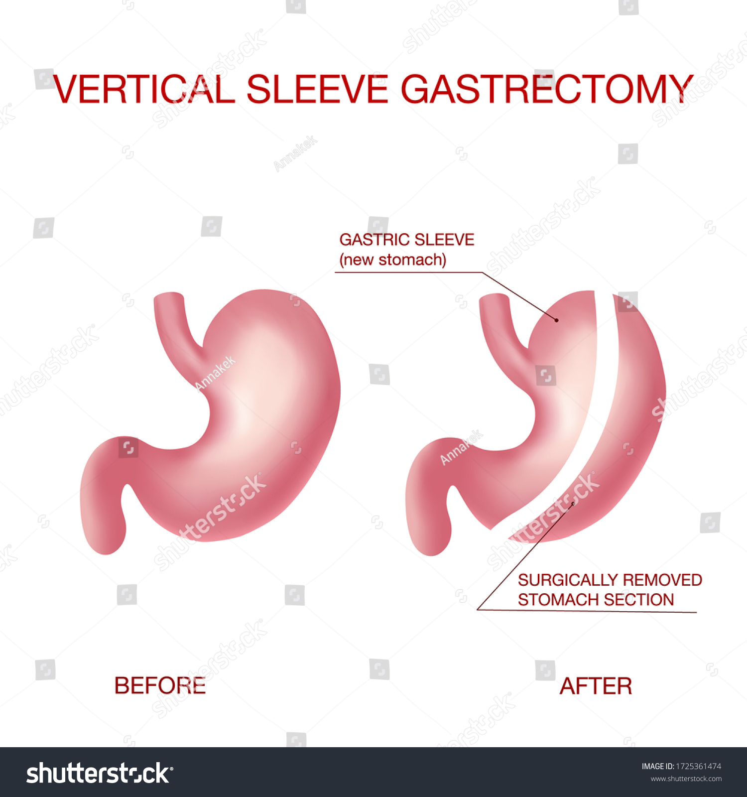 Vertical Sleeve Gastrectomy Medical Vector Illustration Stock Vector ...