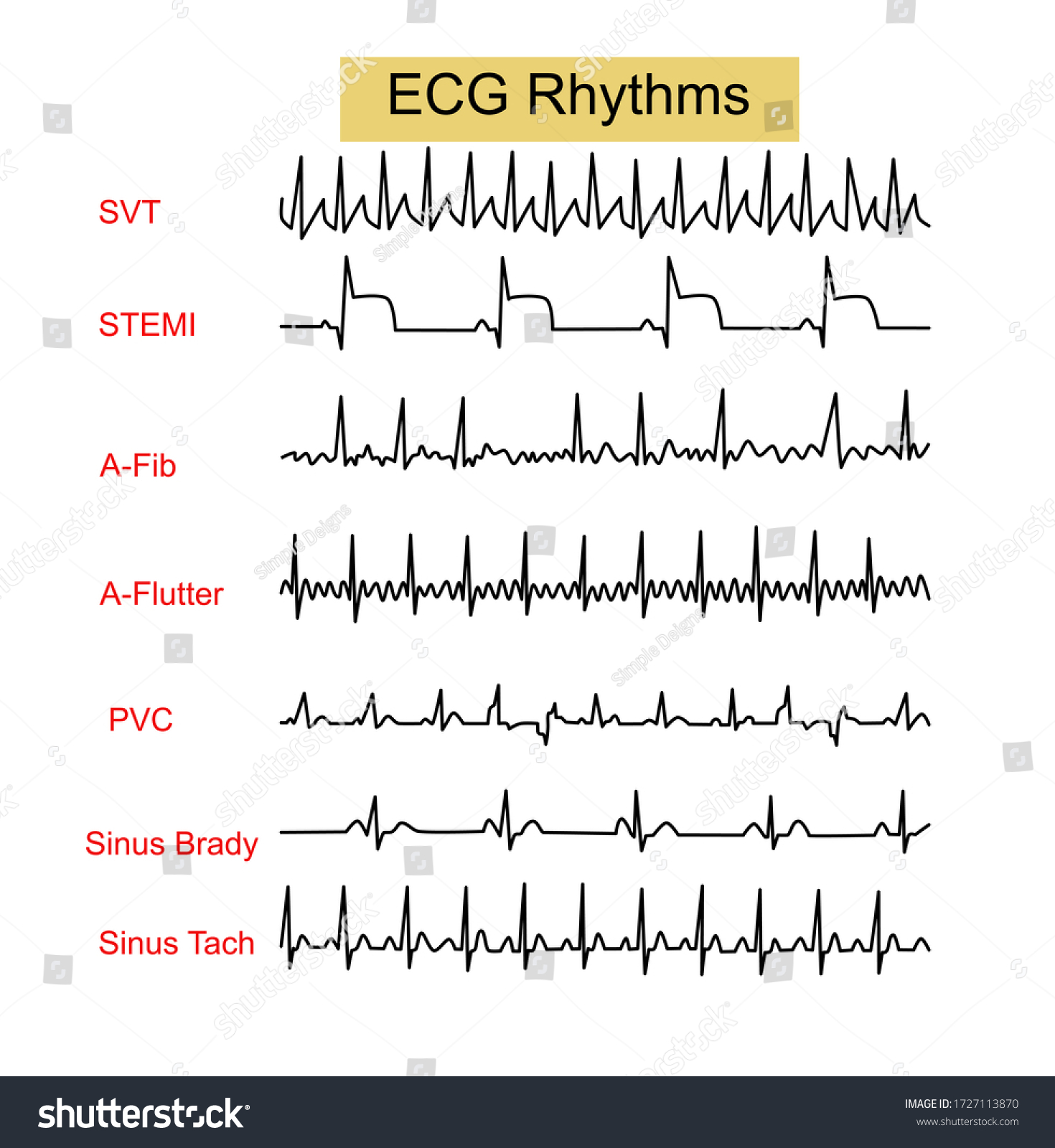 Ecg Rhythms Supraventricular Tachycardiasvtst Elevation Myocardial Stok