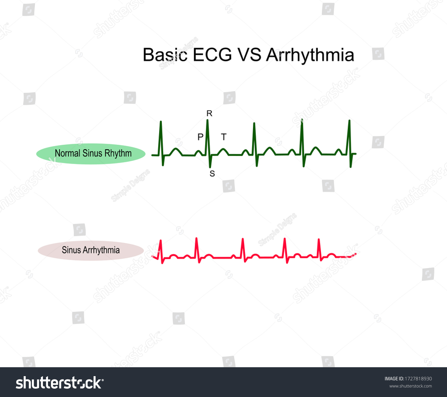 Normal Sinus Rhythm Ecg Sinus Arrhythmia Vector Có Sẵn Miễn Phí Bản