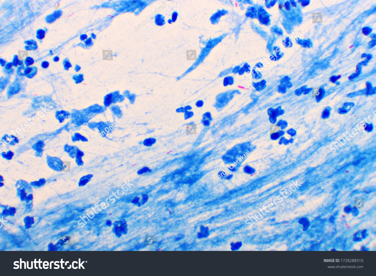Mycobacterium Tuberculosis Positive Small Red Rod Stock Photo ...