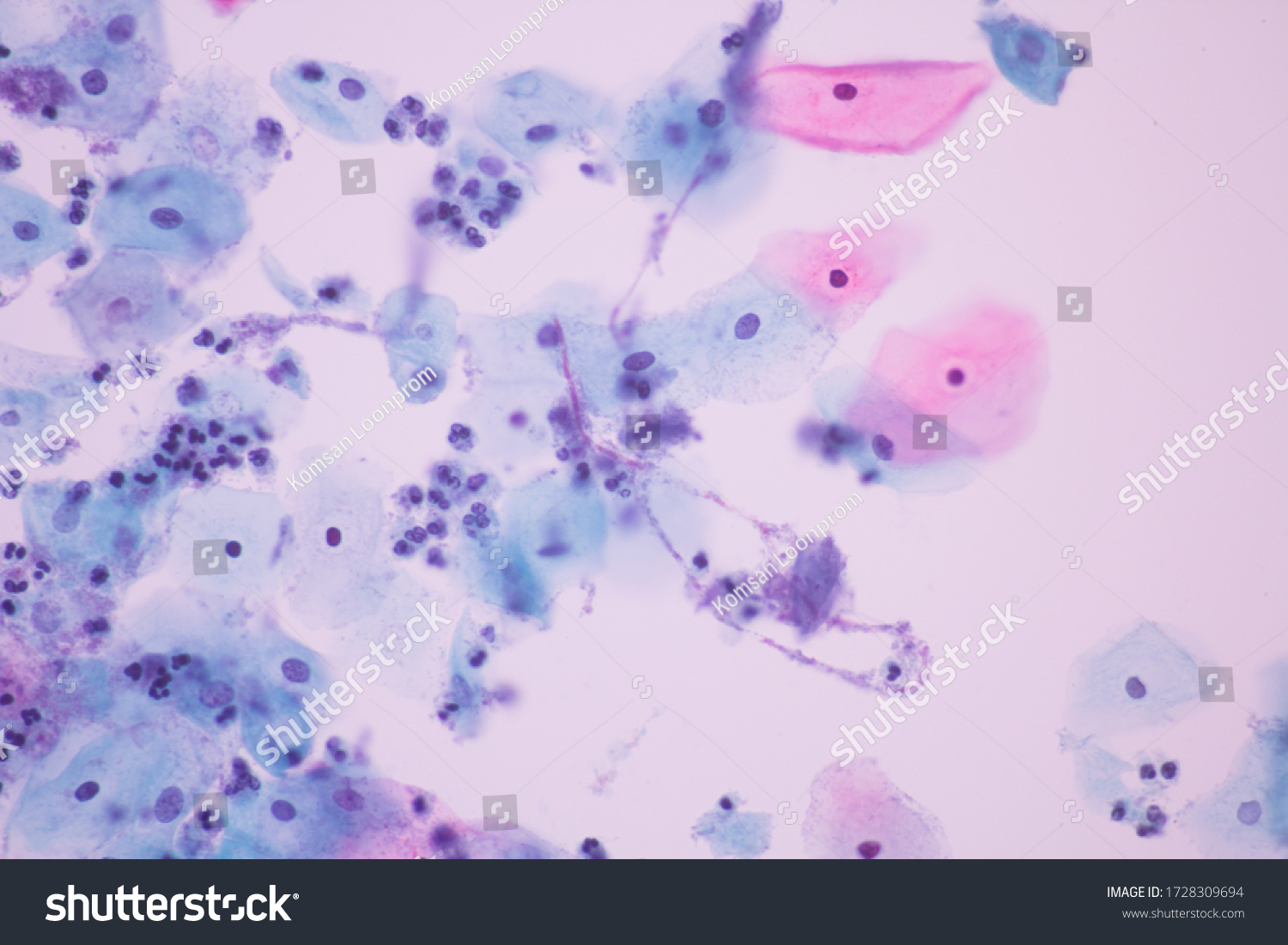 View Microscopic Candidiasis Fungus Infection Yeast Stock Photo ...