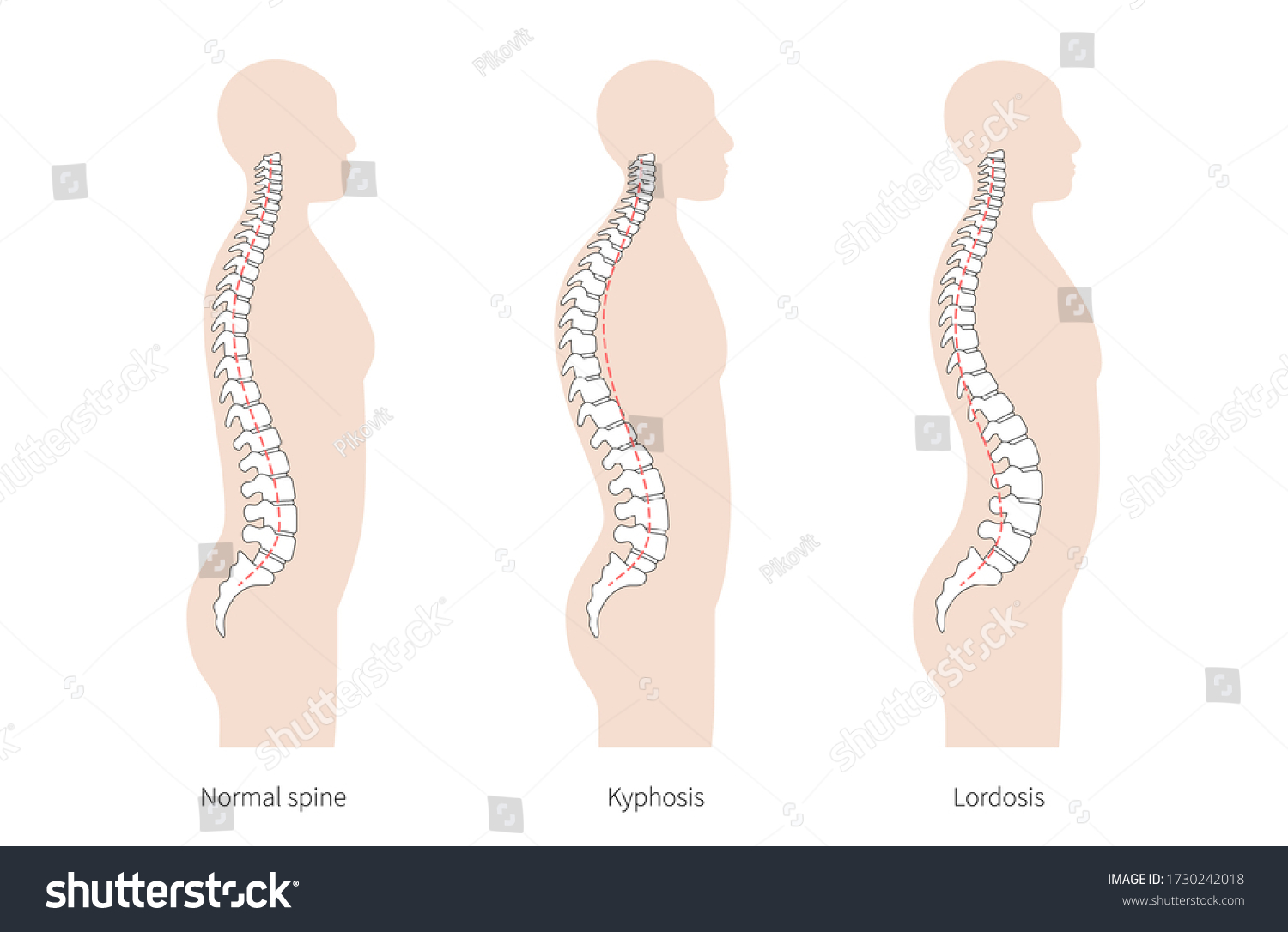 Spinal Deformity Flat Vector Illustration Kyphosis Stock Vector ...