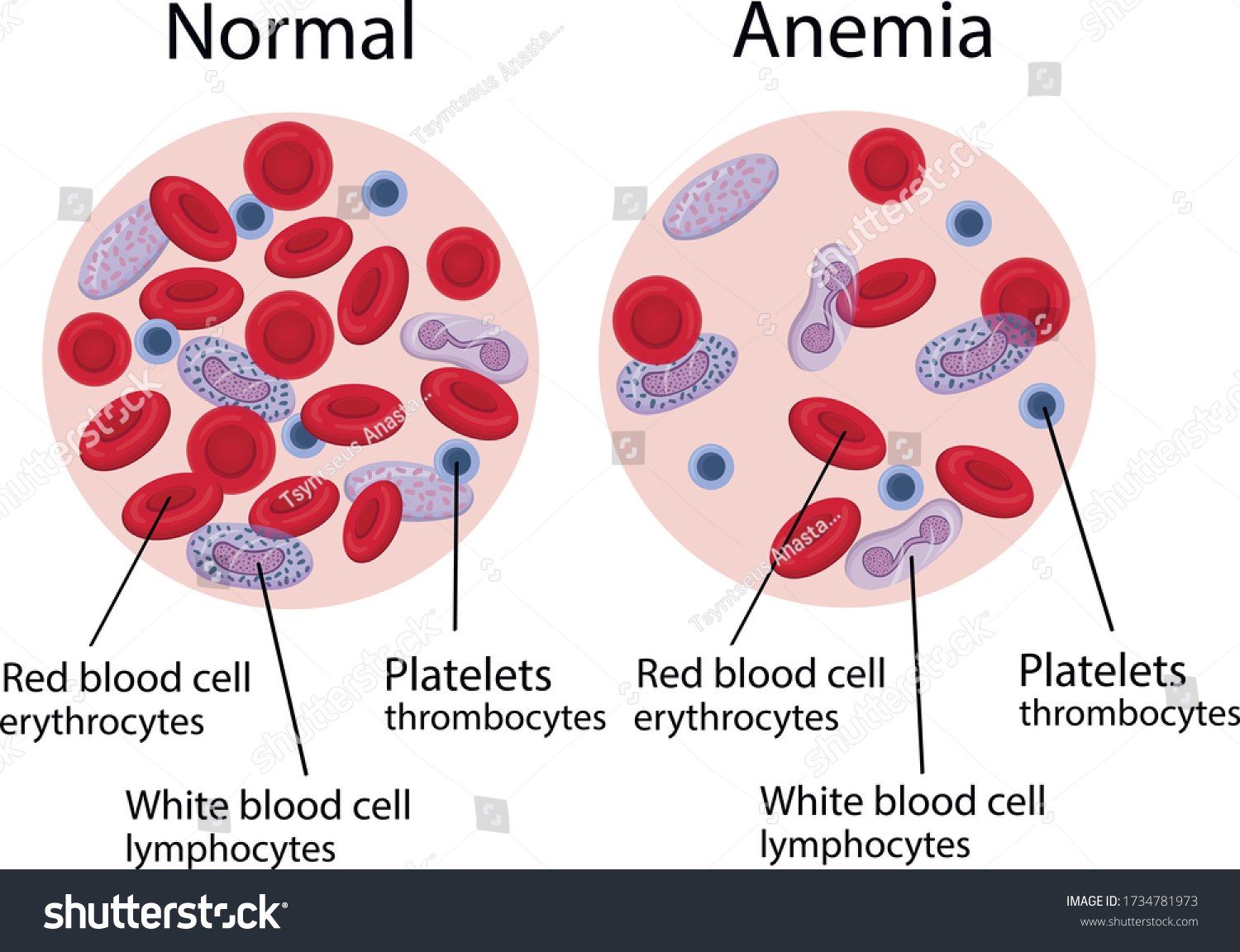 vector-illustration-anemia-blood-composition-stock-vector-royalty-free-1734781973-shutterstock