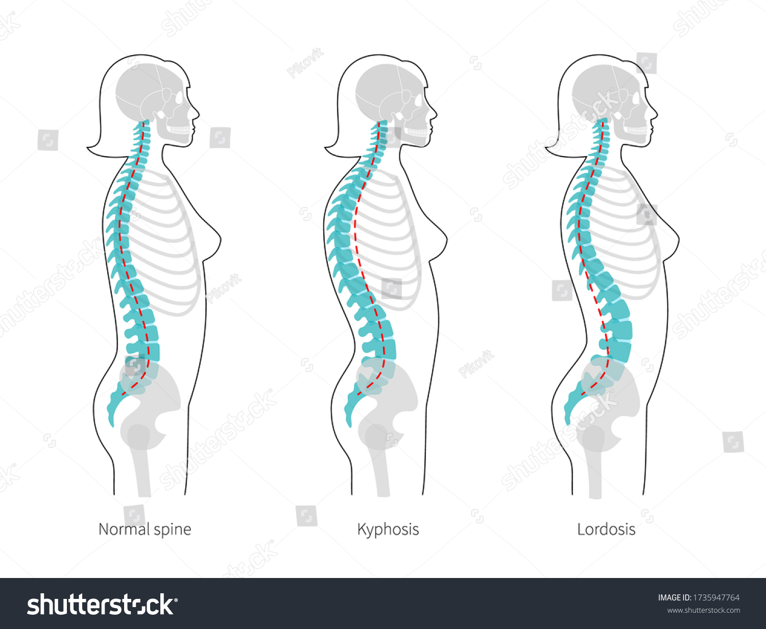 Woman Spinal Deformity Flat Vector Illustration Stock Vector (Royalty ...