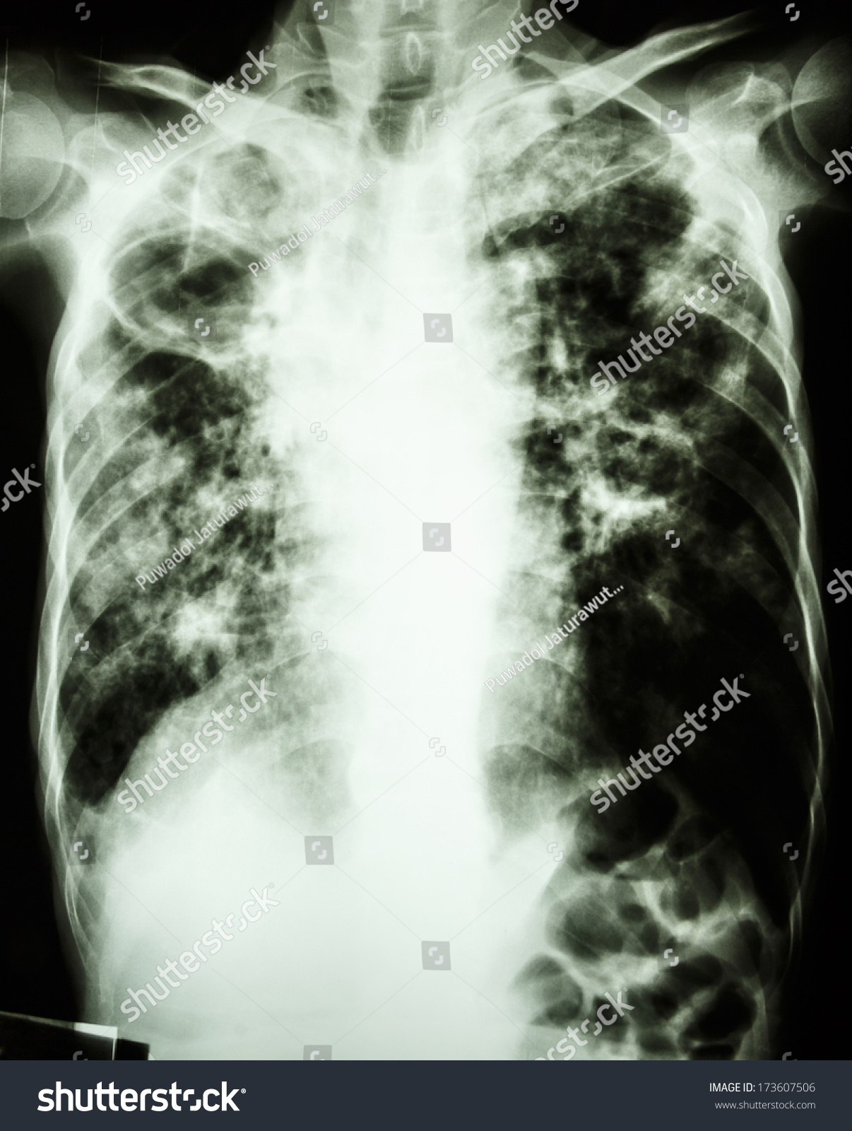 Film Chest Xray Show Cavity Right Stock Photo 173607506 | Shutterstock