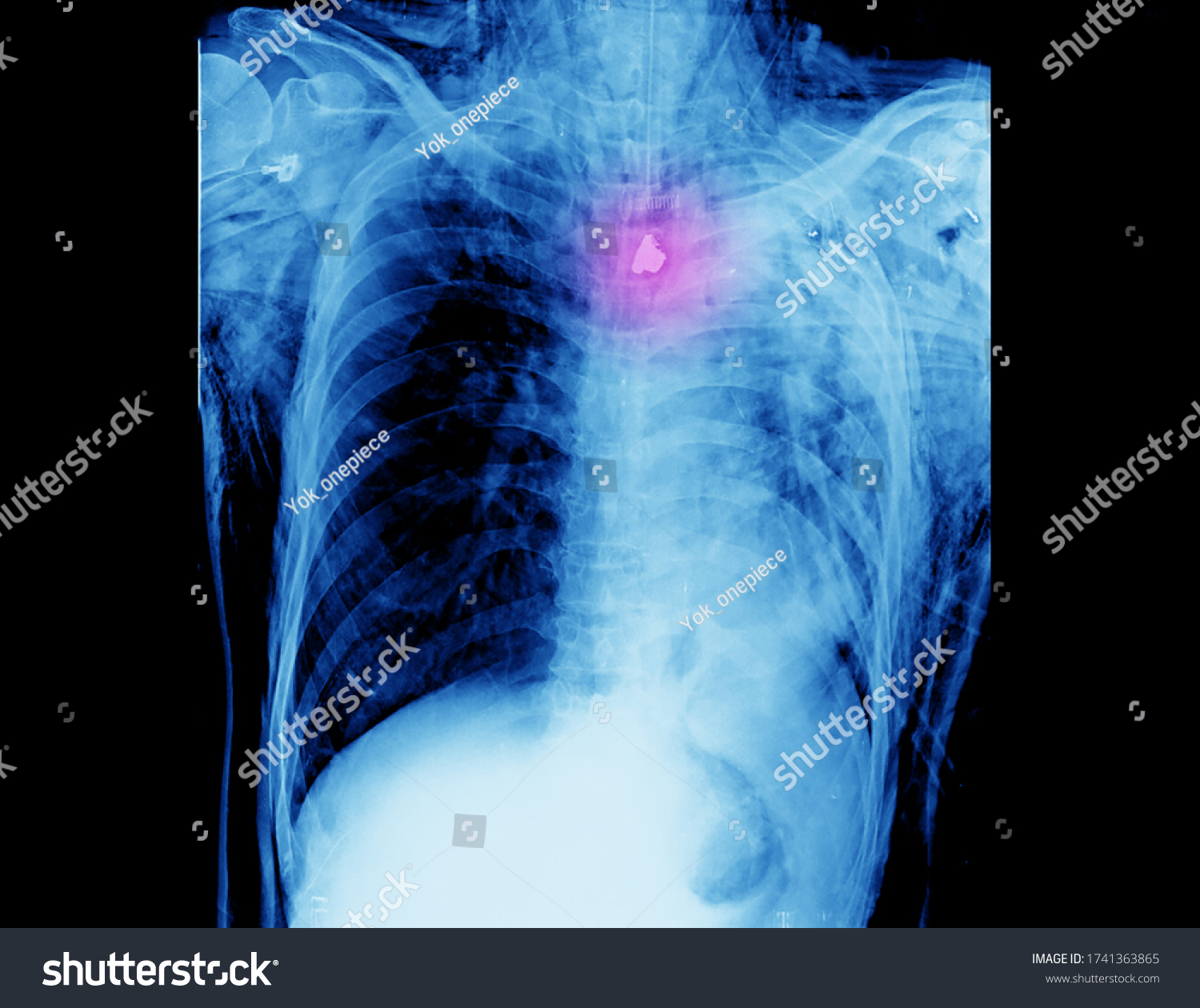 Chest Xray Gun Shot Wound Patient Stock Photo 1741363865 | Shutterstock