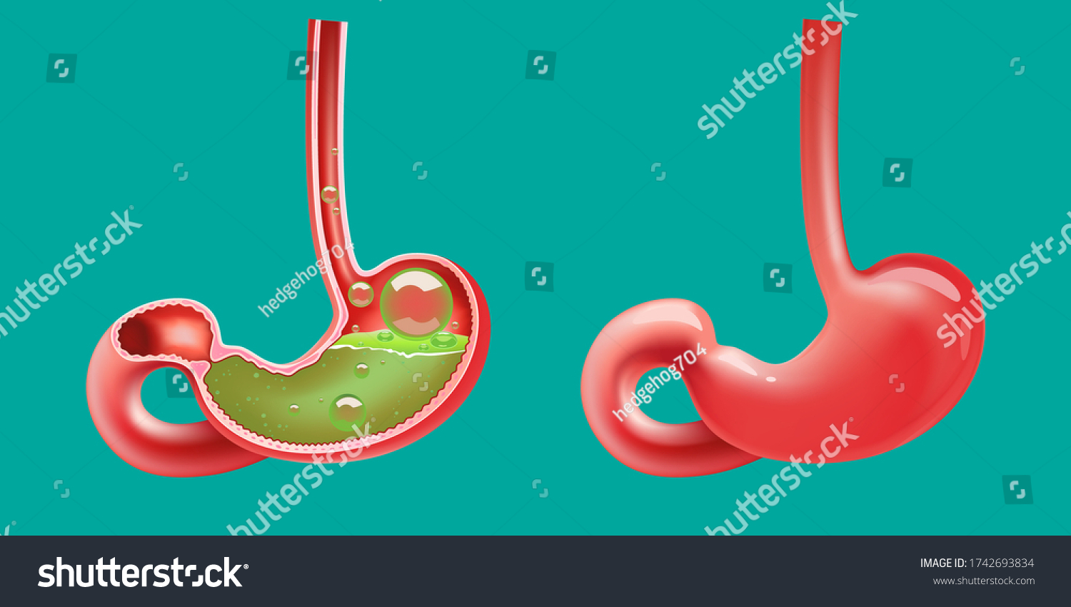 Gastroesophageal Reflux Disease Acidity Upset Pain Stock Vector 