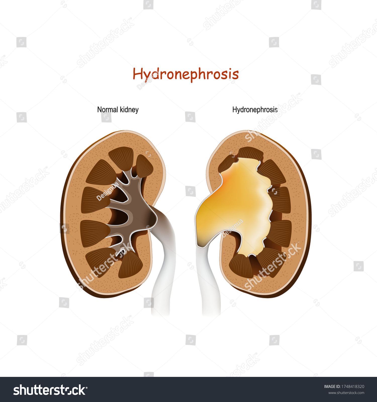 Hydronephrosis Normal Kidney Kidney Disorders Dilation Stock Vector ...