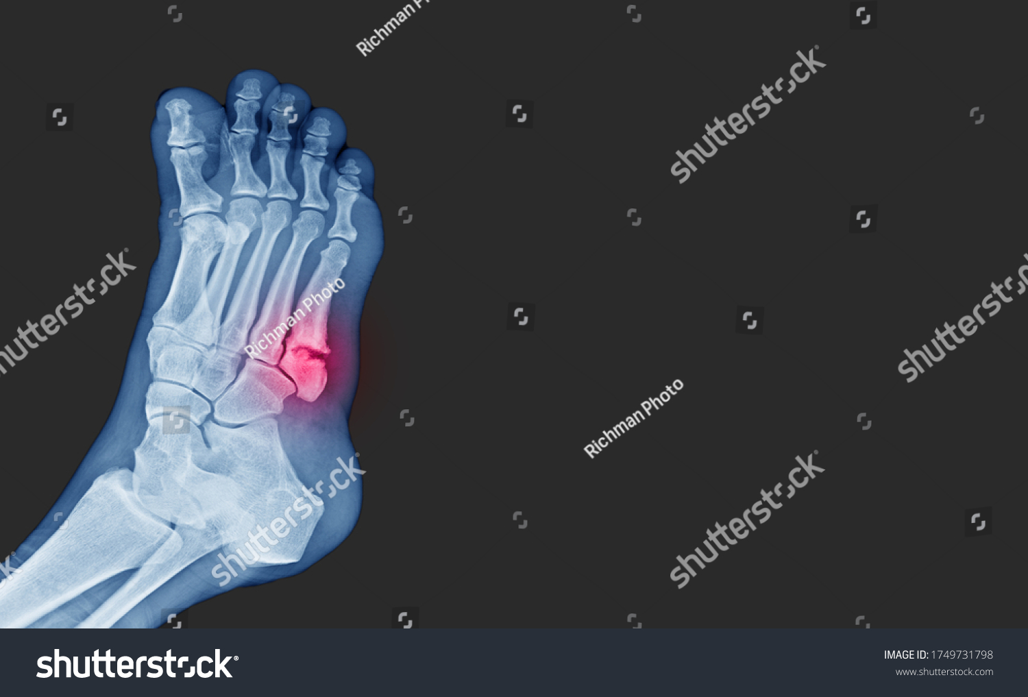Рентген снимок стопы 5 плюсневой кости