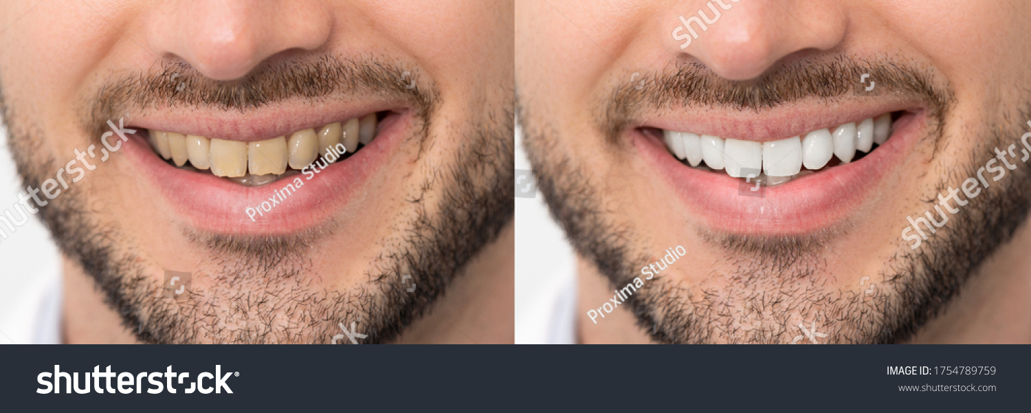 401 Bad Teeth Before After Images, Stock Photos & Vectors | Shutterstock