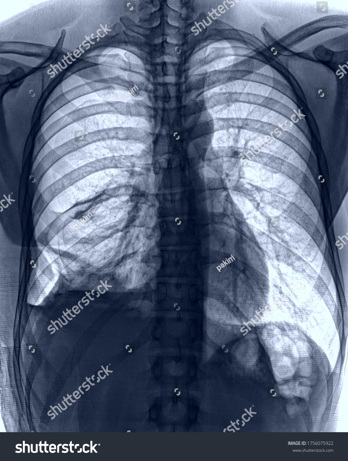 Chest X Ray Pneumonia Complicated Pleural Stock Photo 1756075922 ...