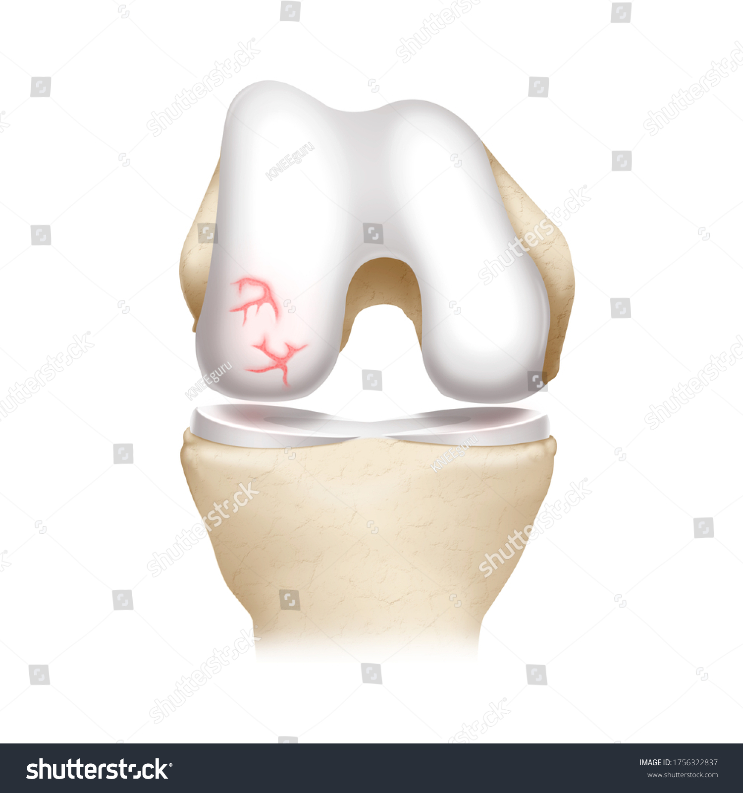 Anterior View Flexed Knee Showing Fissuring Stock Illustration ...