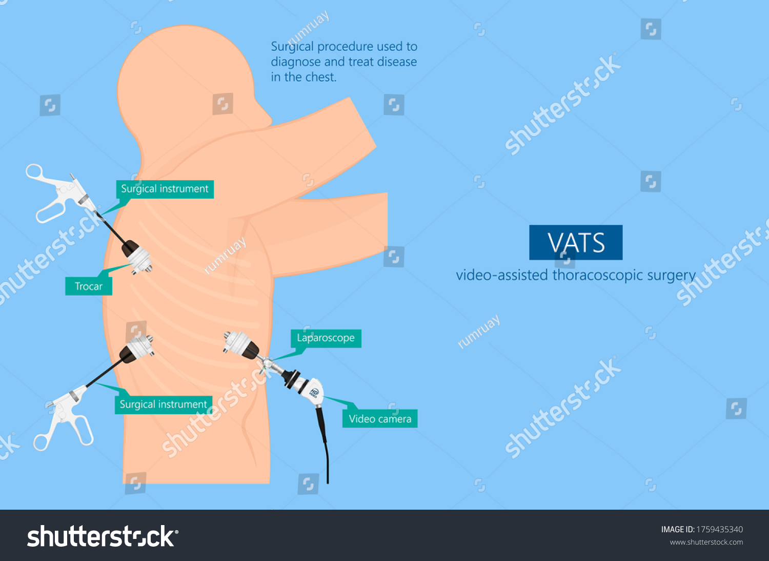 Vats Lung Cancer Treatment Sub Pus Stock Vector Royalty Free 1759435340 Shutterstock