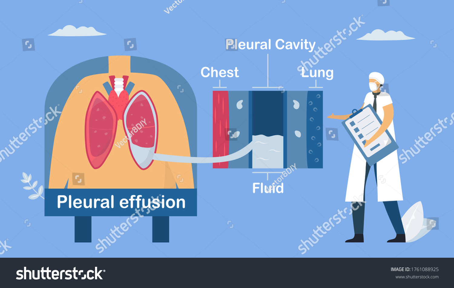 Pleural Effusion Collection Excess Fluid Between Stock Vector Royalty Free 1761088925