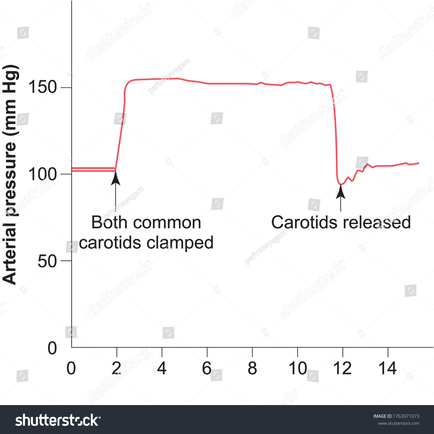 Typical Carotid Sinus Reflex Effect On Stock Vector (Royalty Free ...