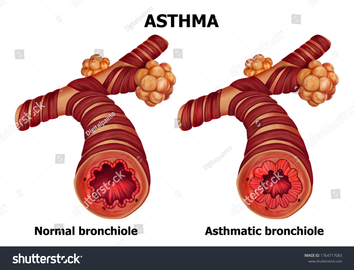 Illustration Human Asthma Anatomy Stock Illustration 1764717083 ...