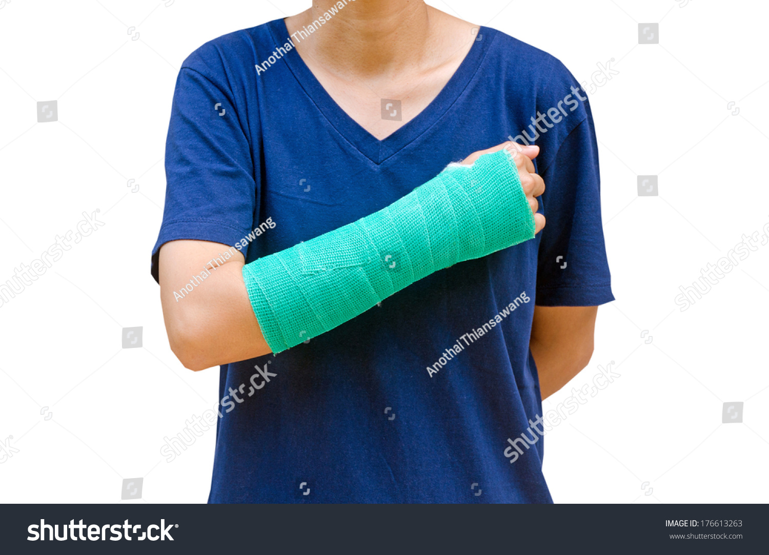 green arm cast