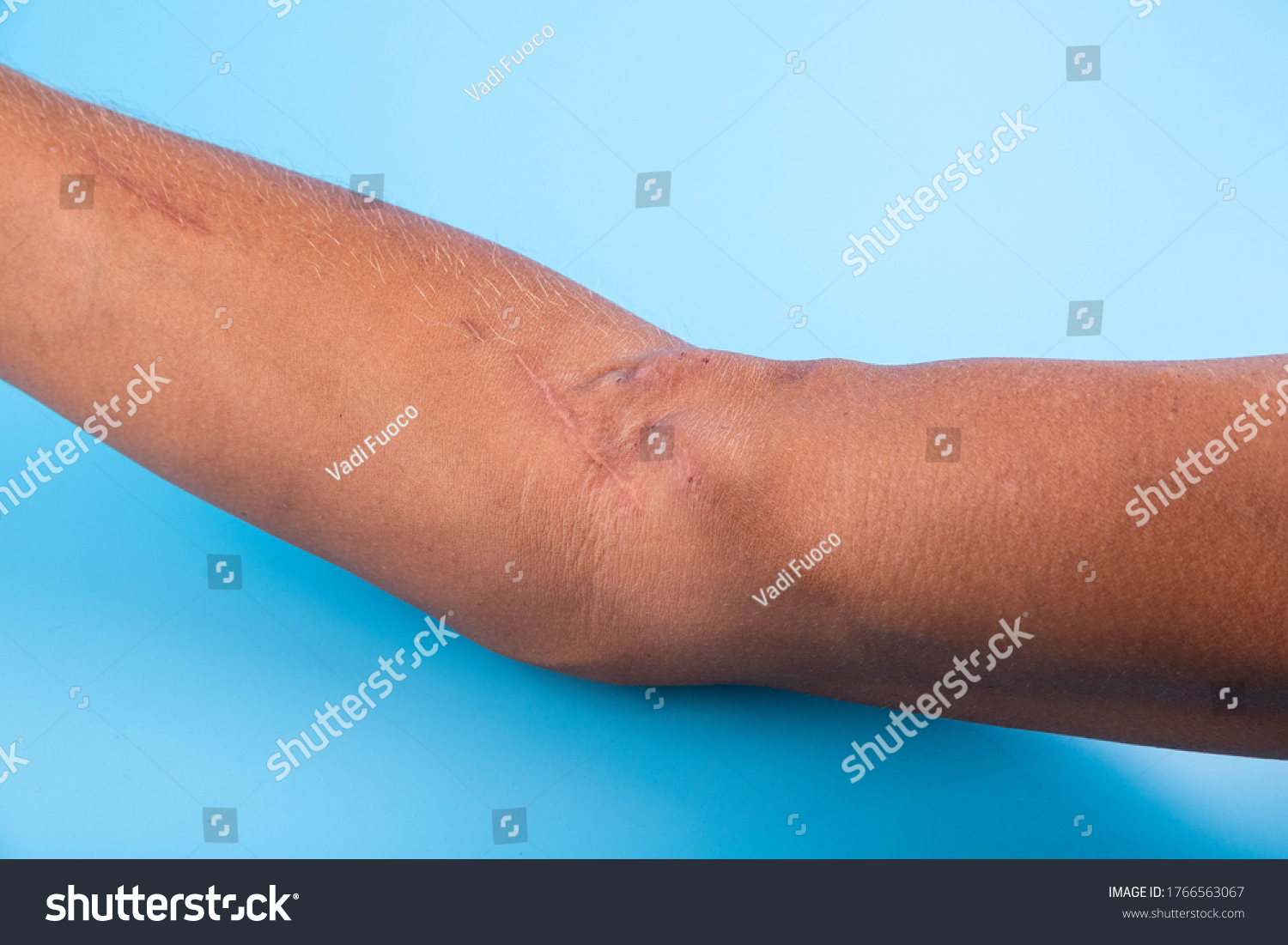 Fistula On Arm Result Operation Hemodialysis Stock Photo 1766563067