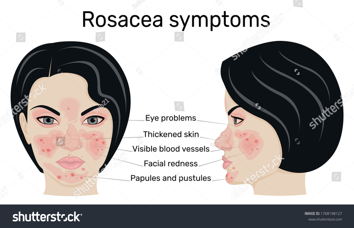 Illustration Symptoms Rosacea On Example Female Stock Vector (Royalty ...