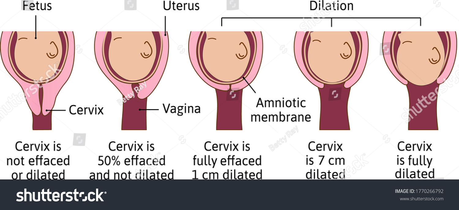 cervical-effacement-dilation-during-delivery-cervix