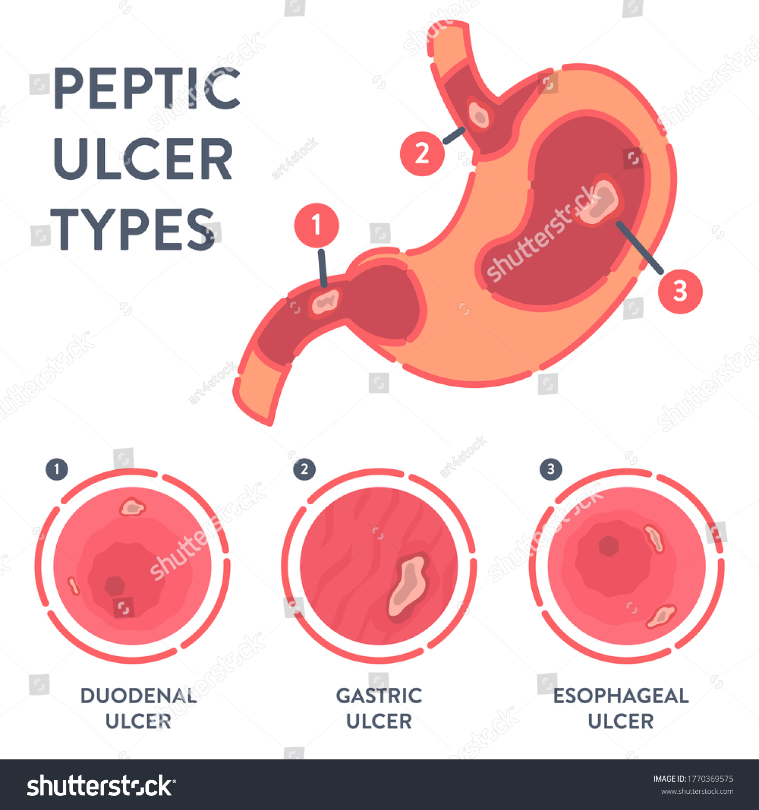 Vektor Stok Peptic Ulcer Stomach Disease Infographic Poster Tanpa Royalti 1770369575