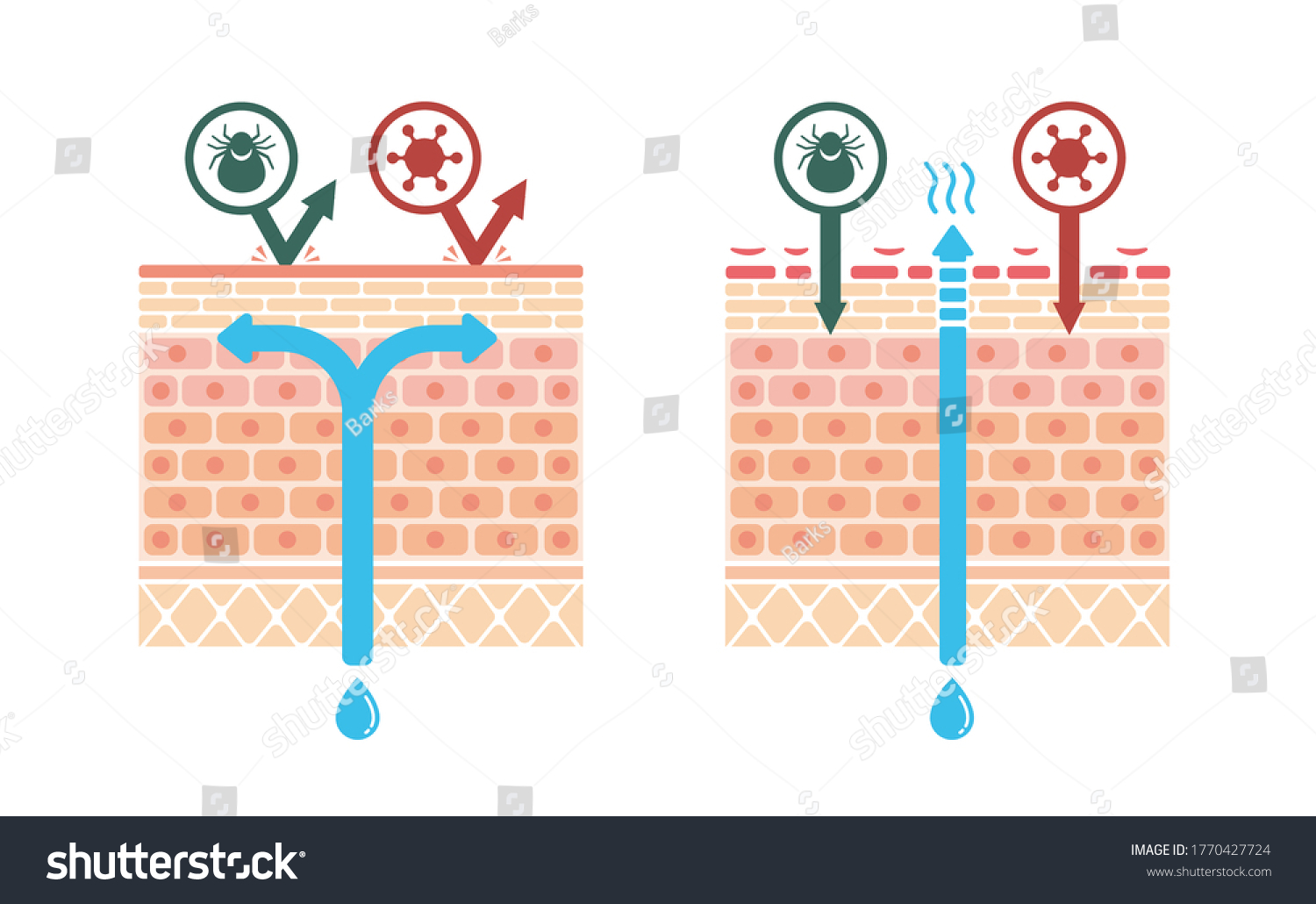 Sectional View Atopic Dermatitis Normal Skin Stock Vector (Royalty Free ...