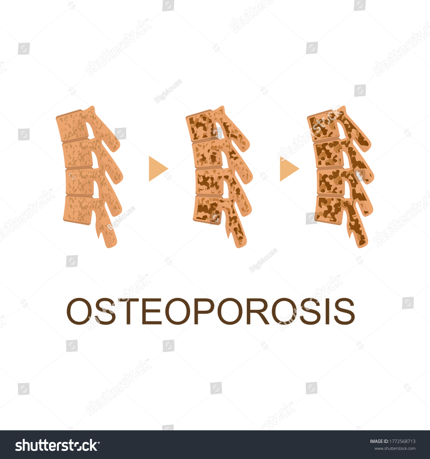 Osteoporosis Bone Infographics Concept Card Poster Stock Vector ...