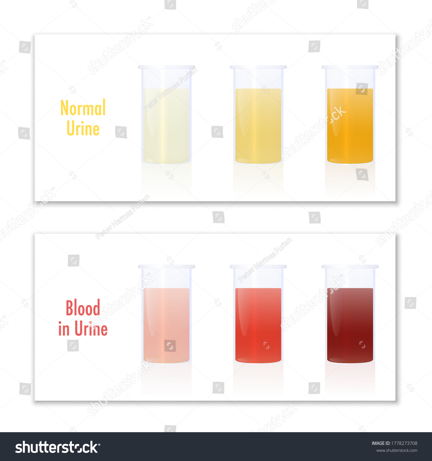 Blood Urine Normal Urine Specimen Cups Stock Vector (Royalty Free ...