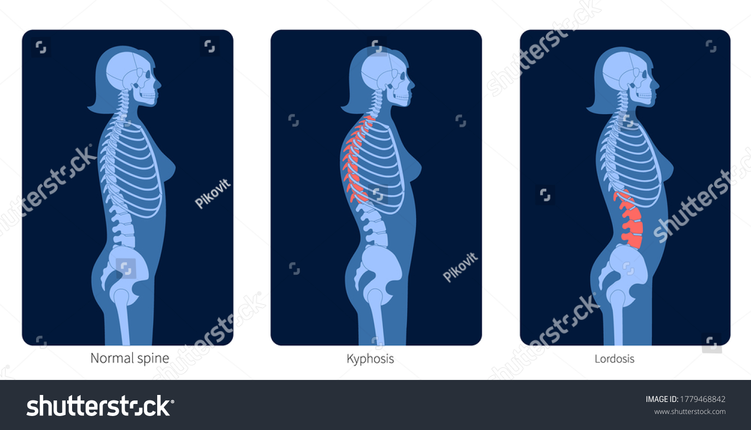 Normal Spine Lordosis Kyphosis Scoliosis Female स्टॉक वेक्टर (रॉयल्टी ...